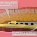 Liposuccion. 3D, and Animation project by Josafath Ponce - 04.09.2017