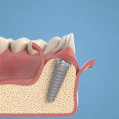 Dental Animations. 3D Animation project by Andres - 03.19.2021