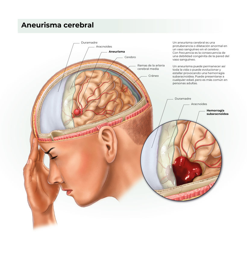 Brain aneurysm 1