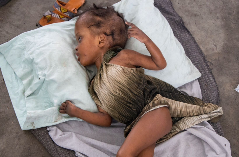 a child awaiting a rare disease in a shelter camp in Port-au-Prince, Haiti, 2024. (Photo/Pierre Marckins)